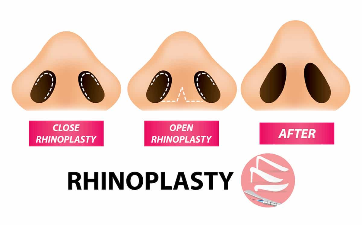 Rhinoplasty in Houston Open vs Closed Surgical Approach